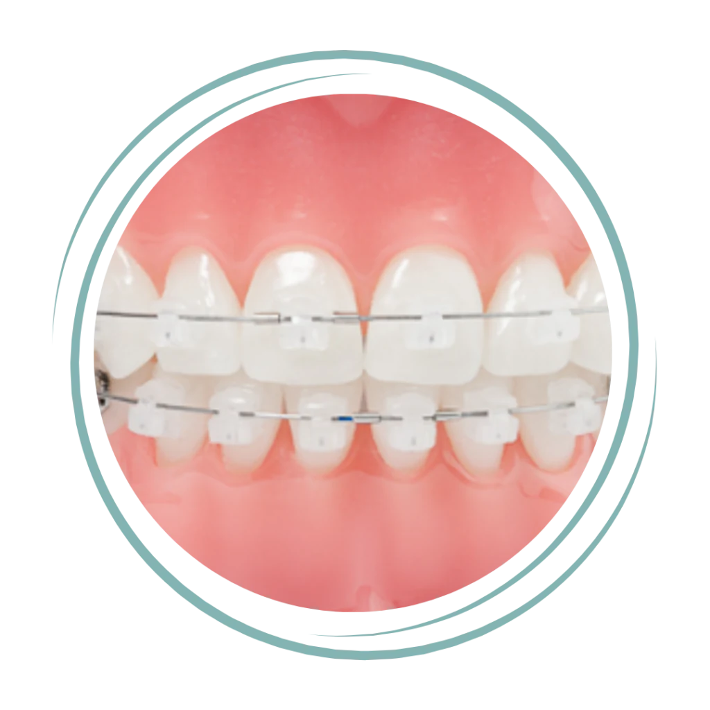 Clear Braces and Aesthetic Brackets