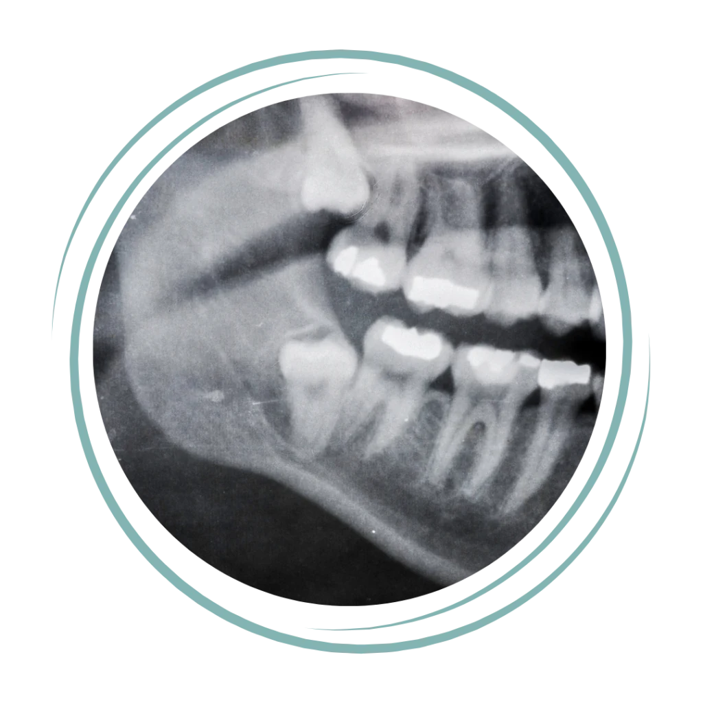 Orthodontic Treatment for Impacted Teeth