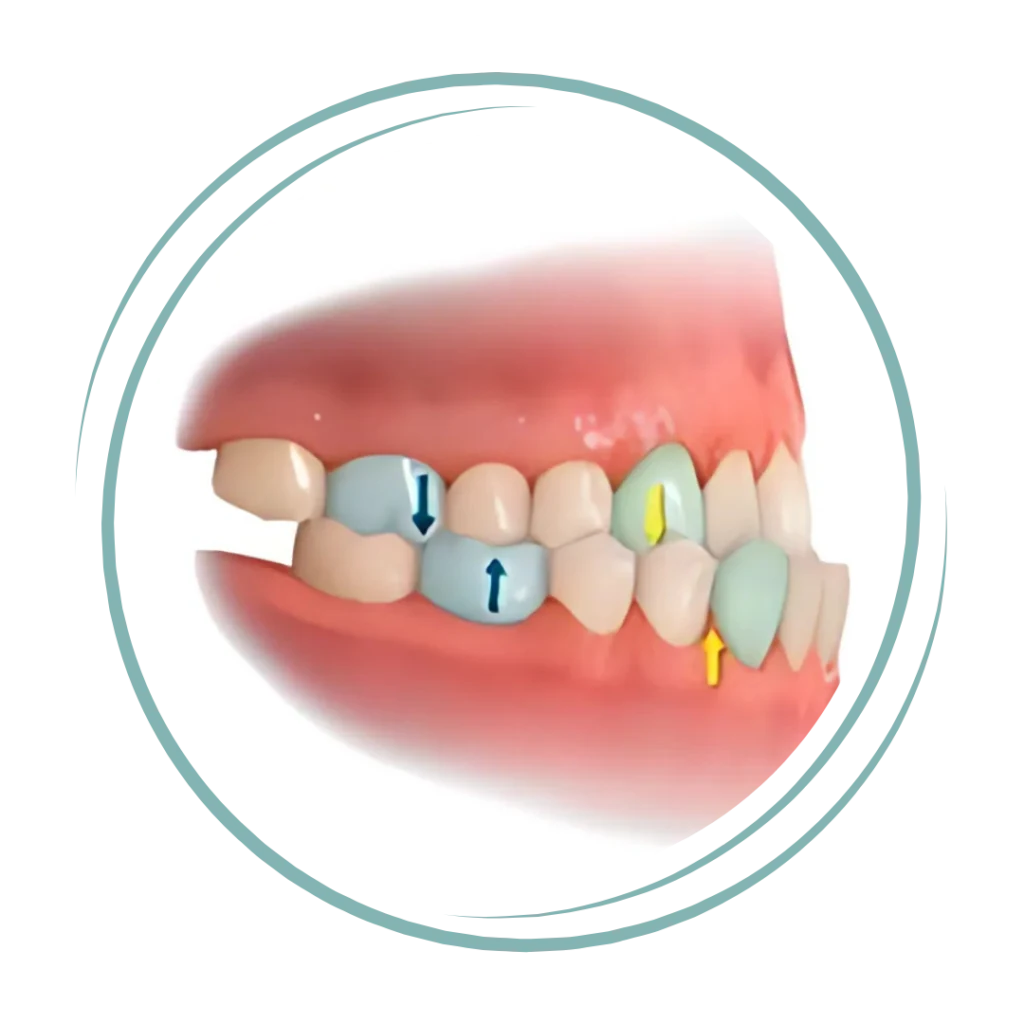 Class I, II and III Malocclusions