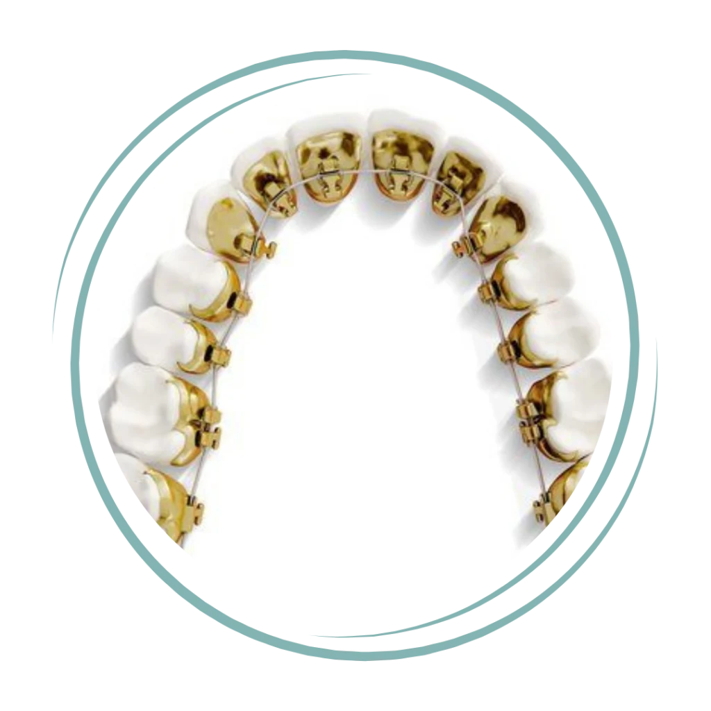 Incognito and Lingual Orthodontic Treatment