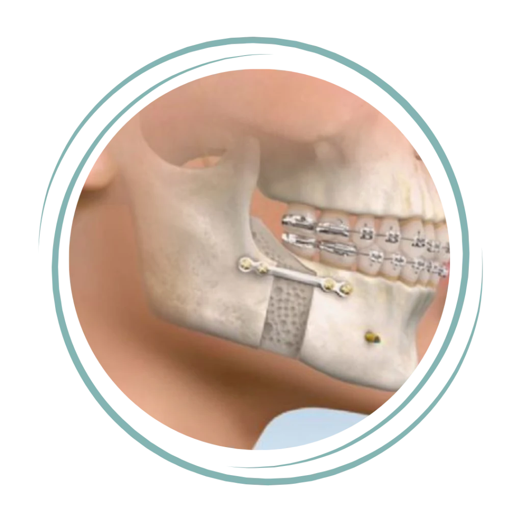 Orthognathic Surgery